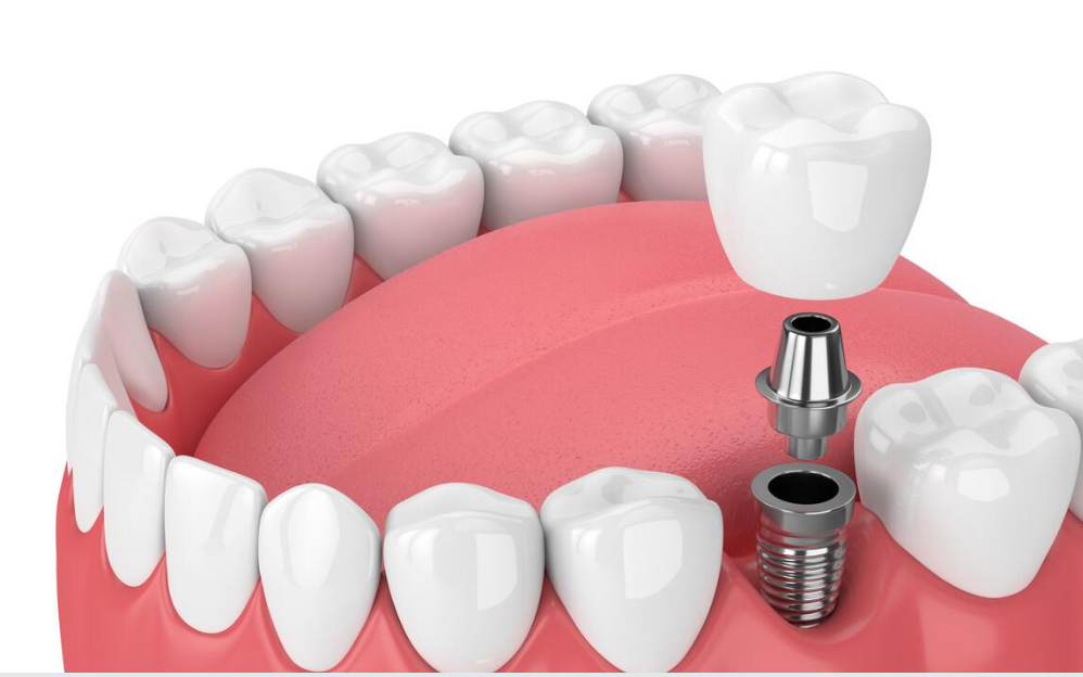 种植牙如何选择？植得口腔医生提醒，这份专业指南助您避坑选对！