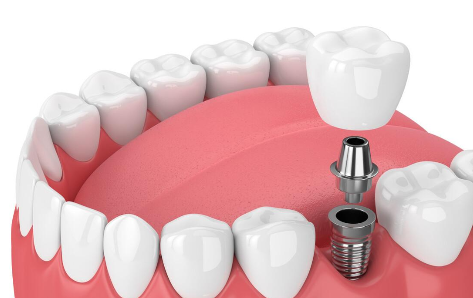 植得口腔荥阳院区孙泽华医生:老年人牙齿缺失?正确修复很关键