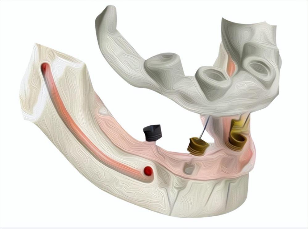 让种牙更精确!带你了解植得口腔数字化3D导板种植技术