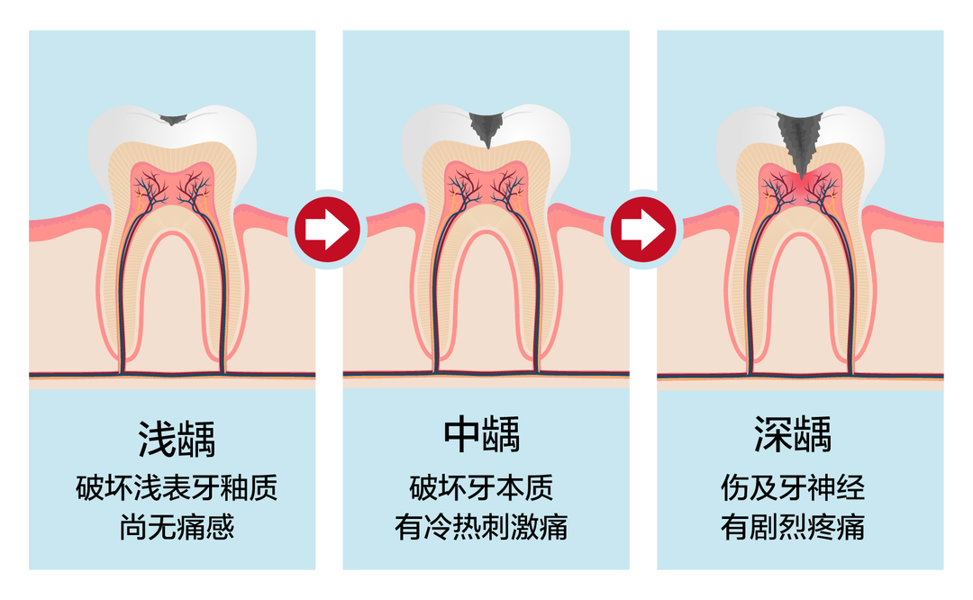 小洞不补，大洞受苦:听植得口腔医生说龋齿防治之道