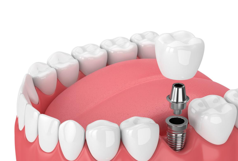 选择种植牙时应该注意哪些关键因素？植得口腔医生专业解读！